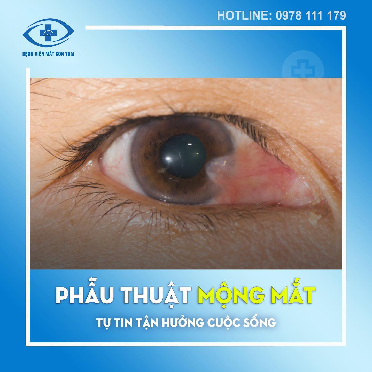 phẫu thuật mộng mắt tại bệnh viện mắt kon tum