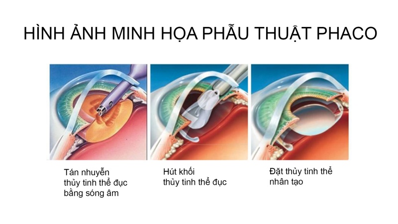 Phau-thuat-phaco-1