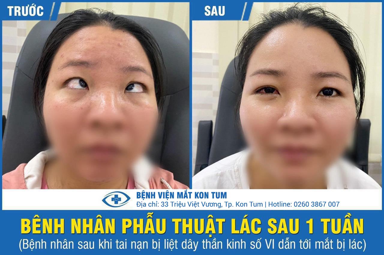 trước-và-sau-phẫu-thuật-lác-lé-tại-bệnh-viện-mắt-kon-tum-02