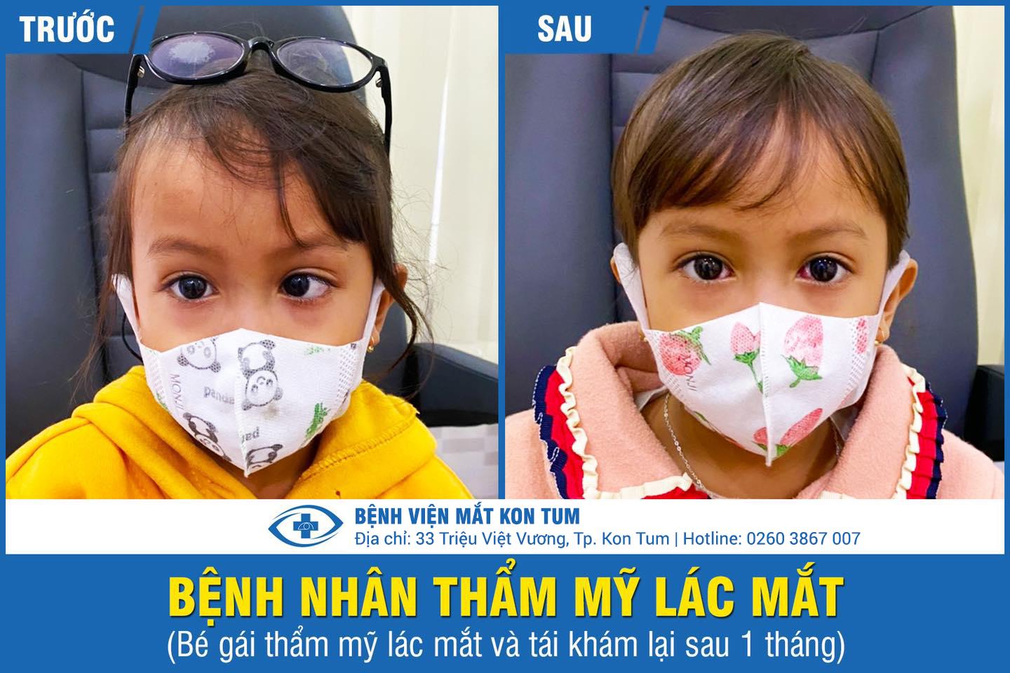 trước-và-sau-phẫu-thuật-lác-lé-tại-bệnh-viện-mắt-kon-tum-03