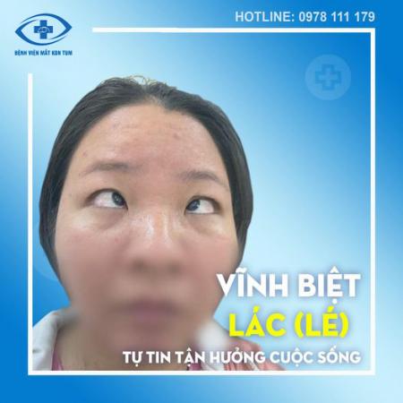 6 cách nhận biết trẻ bị bệnh lý lác lé