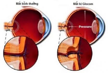 TRIỆU CHỨNG BỆNH GLOCOM