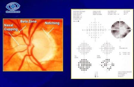 Bệnh TĂNG NHÃN ÁP glocom (thiên đầu thống)