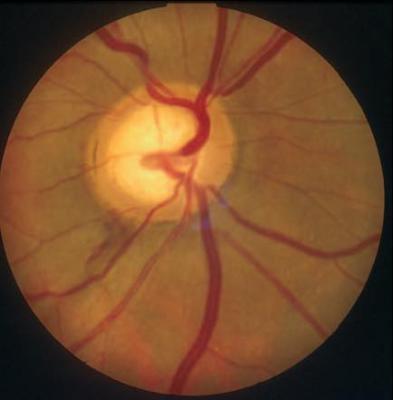 BỆNH GLÔCÔM NHÃN ÁP BÌNH THƯỜNG (NORMAL TENSION GLAUCOMA)