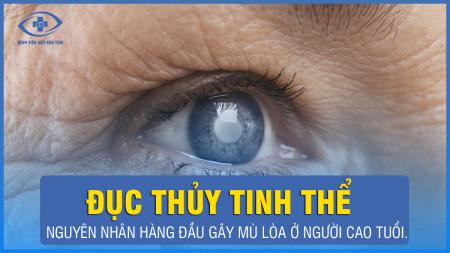 Bệnh đục thủy tinh thể