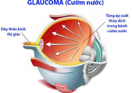 Điều trị Cườm nước