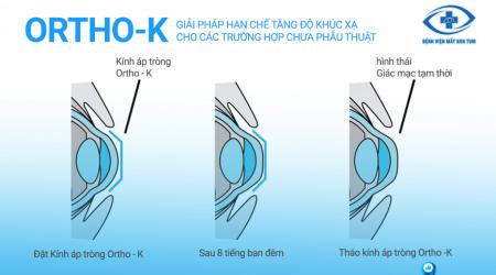 NÊN CHỌN ĐEO KÍNH ORTHO-K HAY PHẪU THUẬT KHÚC XẠ ĐỂ ĐIỀU TRỊ TẬT CẬN THỊ?