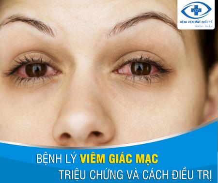 Điều trị Viêm giác mạc