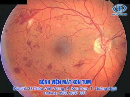 Bệnh Lý Võng Mạc Đái Tháo Đường: Tìm Hểu Cùng Bệnh Viện Mắt Kon Tum